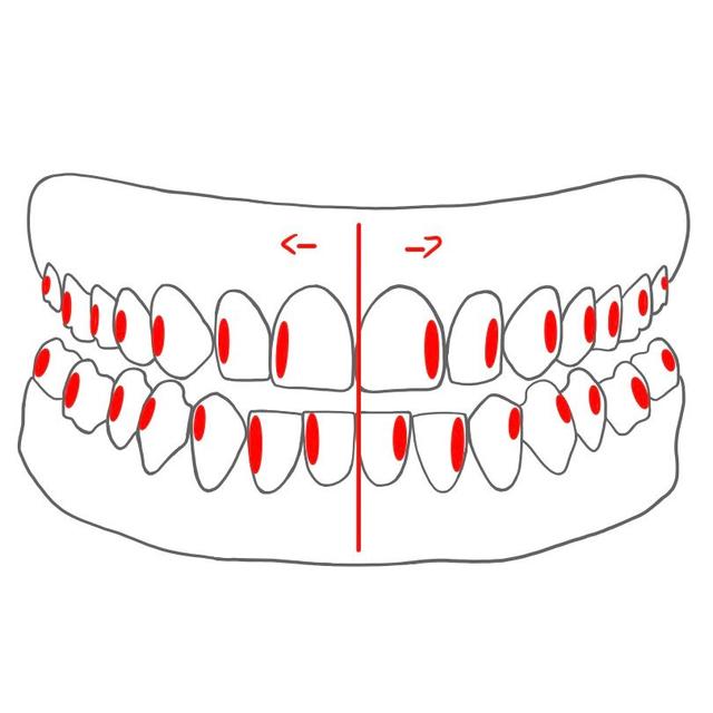 distal (d)   =   von der Zahnbogenmitte weg

- alle Zähne / Kiefer